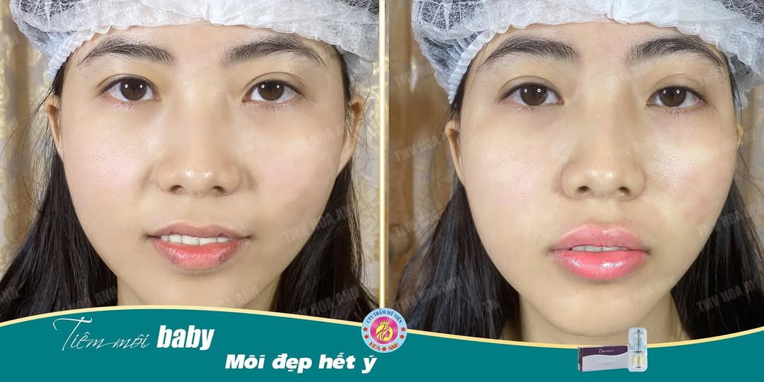 Trước và sau tiêm Filler môi baby tại Hoa Anh